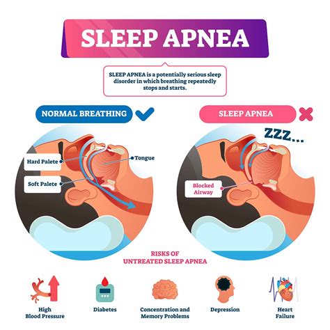 sleep apnea .